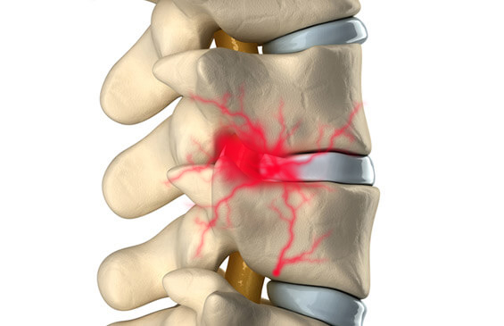 Disc Bulge and Disc Herniation