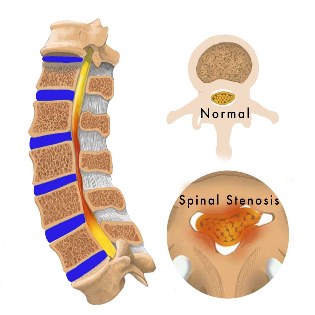 Spinal Instability